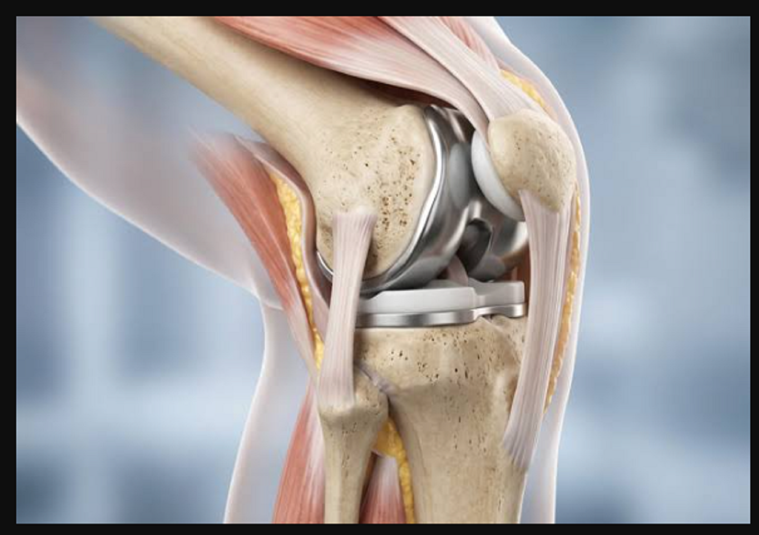 Best Robotic knee Replacement Surgeon in Panchkula
